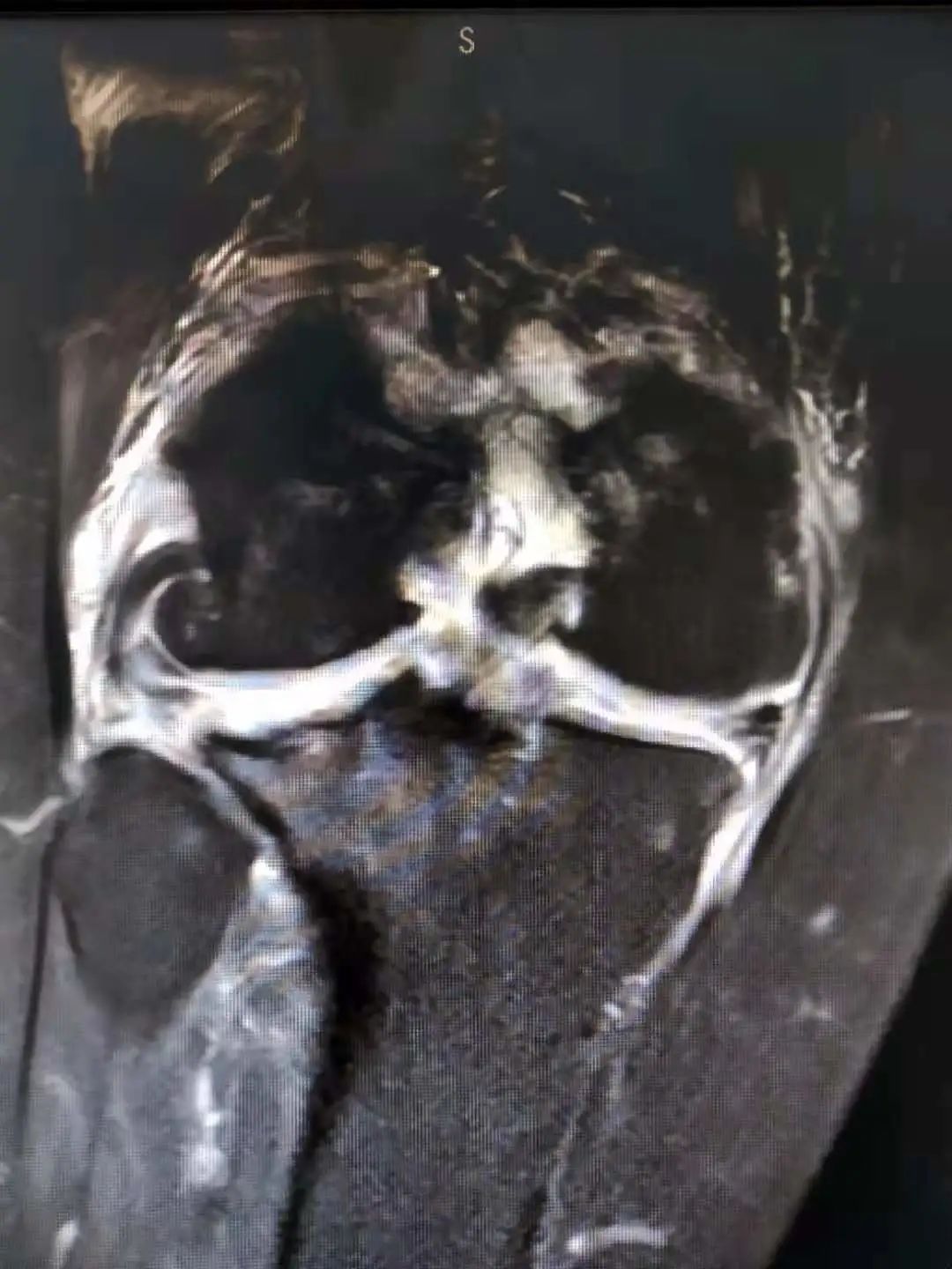 小镜子解决大问题——人民医院骨科开展关节镜微创手术获赞！