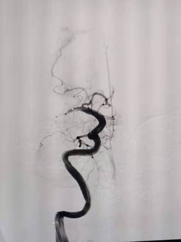 多科联动助力脑血管再通