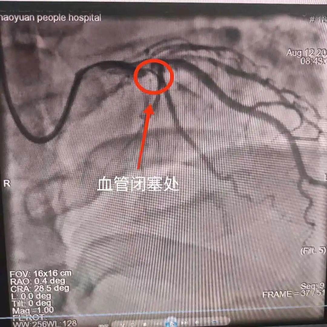 一并拿下！当急性心肌梗死遇上冠脉严重钙化