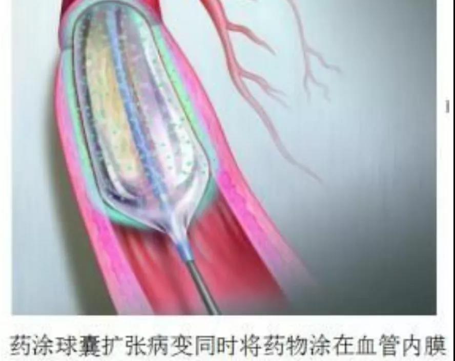 “心”的希望--招远市人民医院开启“介入无植入”新时代